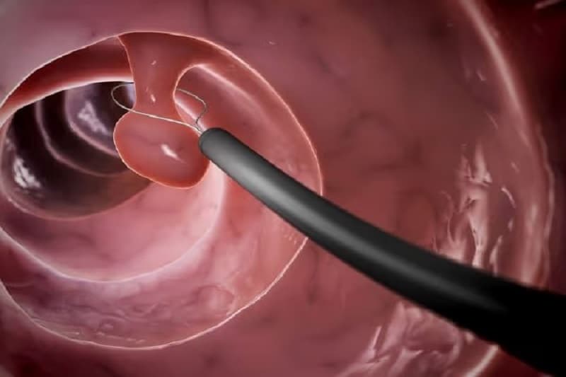 polyp đại tràng sigma 5mm