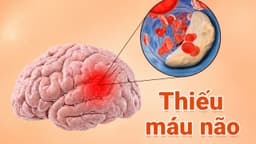 Làm sao biết thiếu máu não? Cách cải thiện hiệu quả