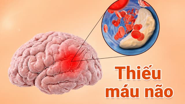 Làm sao biết thiếu máu não? Cách cải thiện hiệu quả