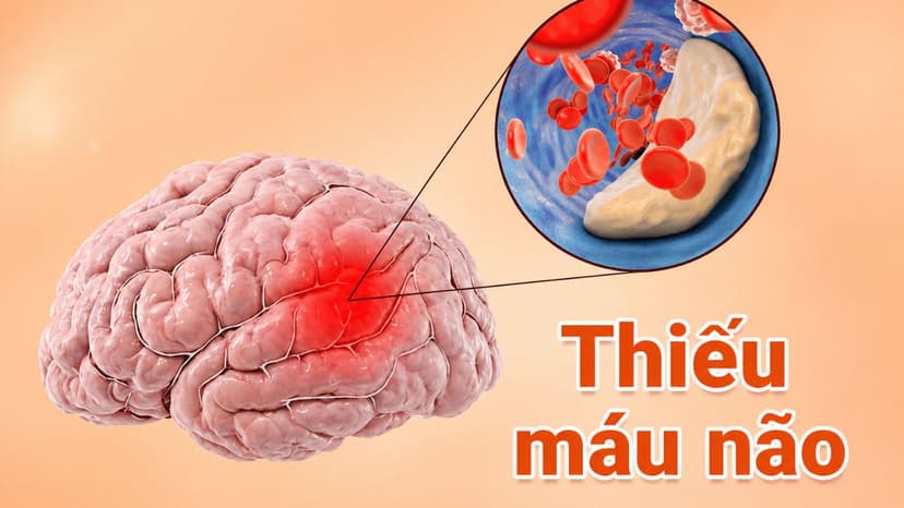 Làm sao biết thiếu máu não? Cách cải thiện hiệu quả