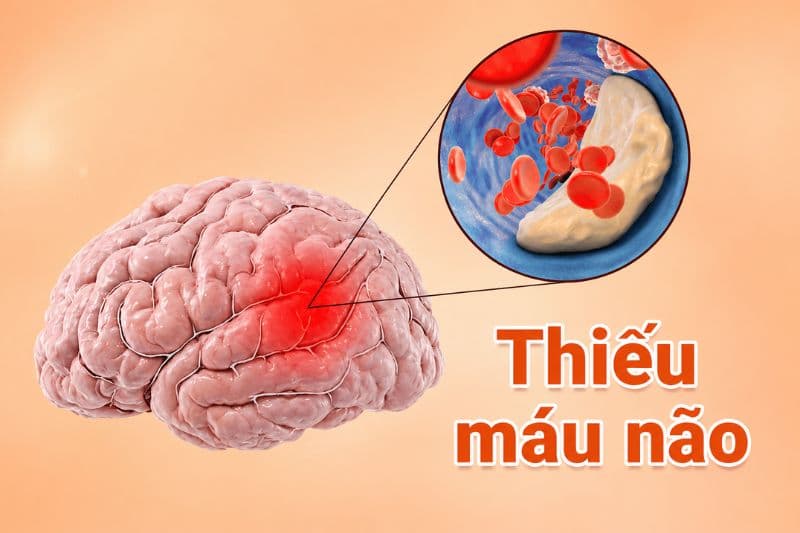 làm sao biết thiếu máu não