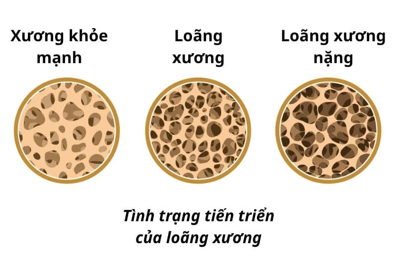Loãng xương cấp độ 4 là giai đoạn nặng nhất của bệnh, khi mật độ xương suy giảm nghiêm trọng và nguy cơ gãy xương tăng cao rõ rệt.