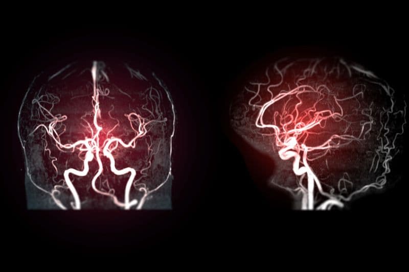 hay bị đau đầu do đâu