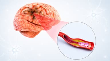 Máu nhiễm mỡ có bị đột quỵ không?