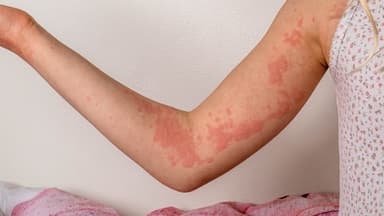 Cảnh giác mề đay do lạnh