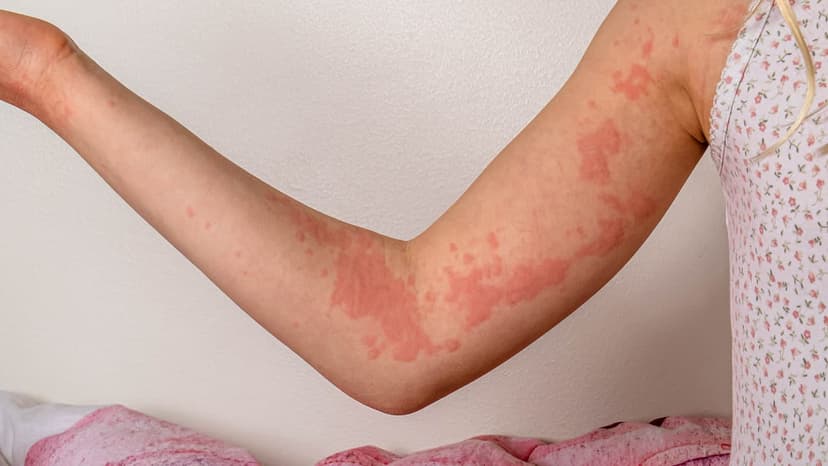 Cảnh giác mề đay do lạnh