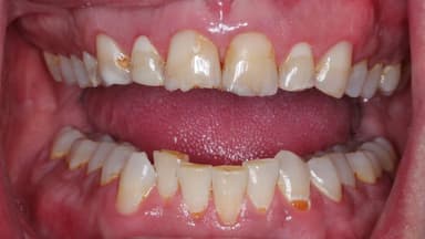 Men răng bị mòn gây ảnh hưởng gì?