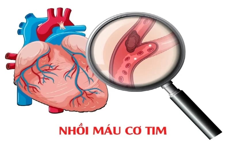 triệu chứng men tim cao