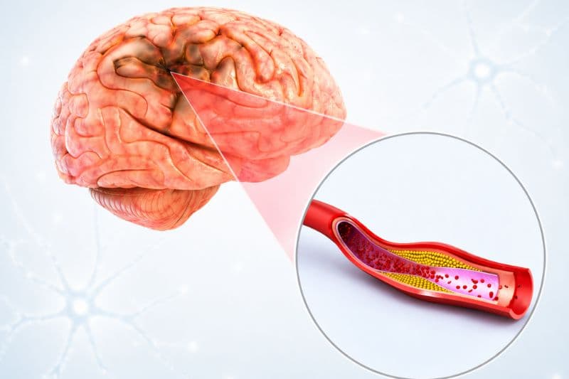 máu nhiễm mỡ có bị đột quỵ không