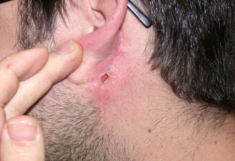 mổ rò luân nhĩ có để lại sẹo không