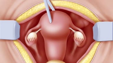 Chỉ định mổ u xơ tử cung cắt bán phần