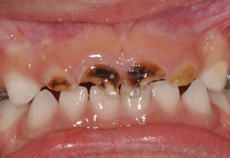 mòn chân răng có trám được không