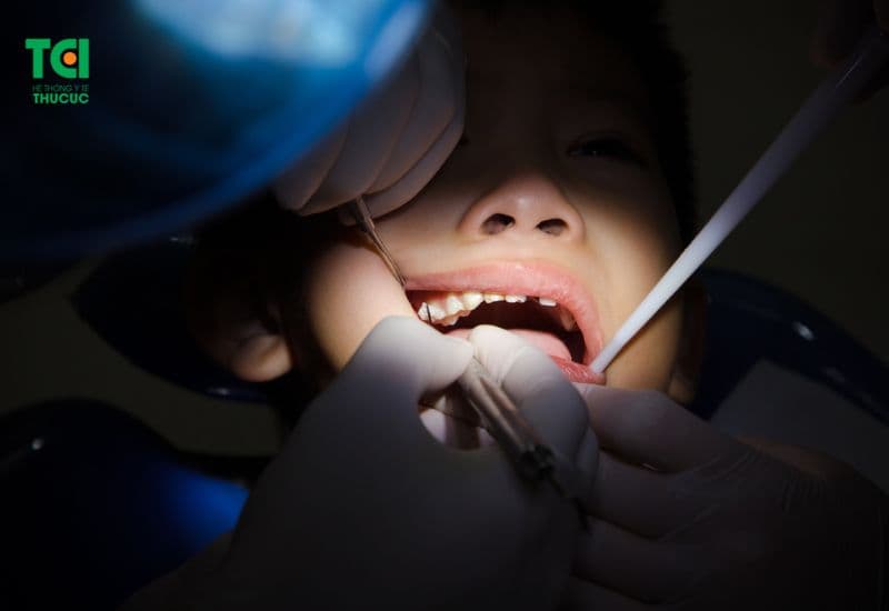 mòn chân răng có trám được không