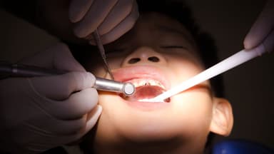 Mòn chân răng có trám được không?