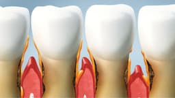 Mòn chân răng ở người lớn chữa thế nào?