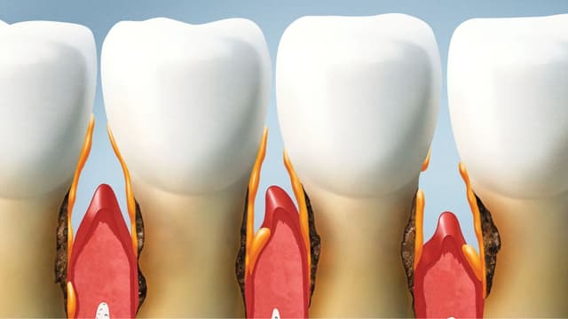 Mòn chân răng ở người lớn chữa thế nào?