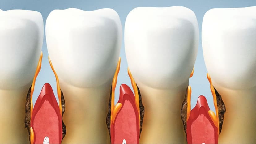 Mòn chân răng ở người lớn chữa thế nào?