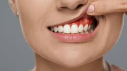 Vì sao có mủ chân răng? Có nên nặn không?