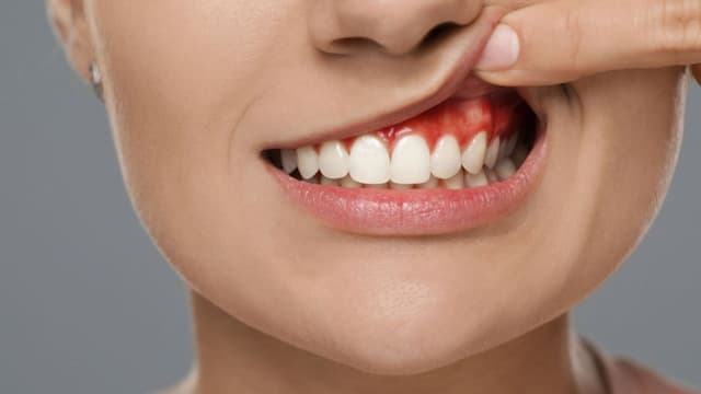 Vì sao có mủ chân răng? Có nên nặn không?