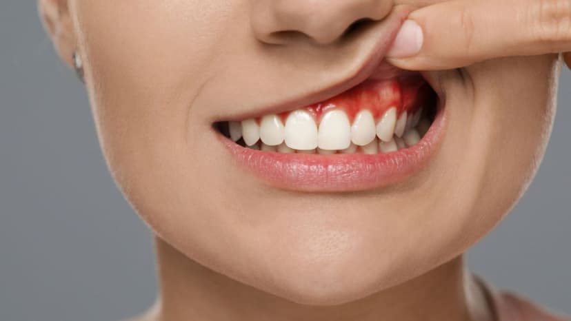 Vì sao có mủ chân răng? Có nên nặn không?