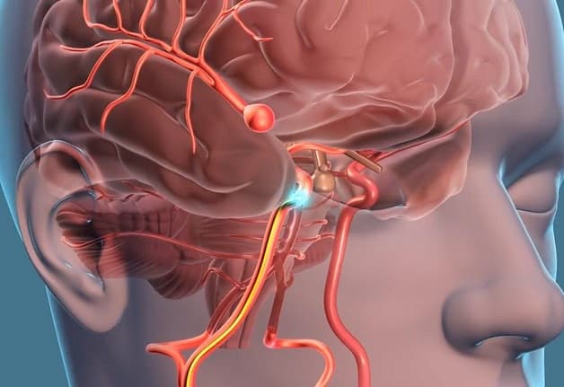 đột quỵ xuất huyết não có nguy hiểm không