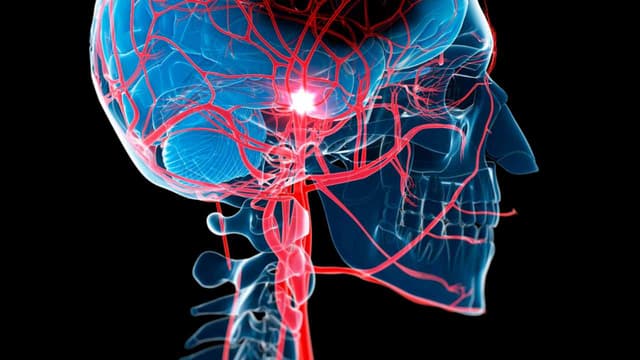 Nhồi máu não diện rộng là gì?