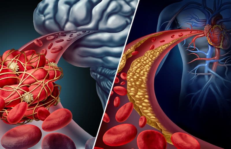 nhồi máu não diện rộng là gì