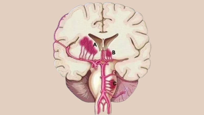 nhồi máu não lỗ khuyết là gì