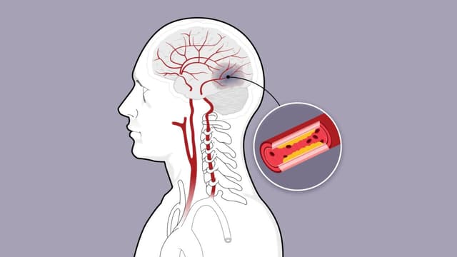 Cảnh giác nhồi máu não tái phát