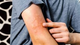 Nổi mề đay có tự hết không?