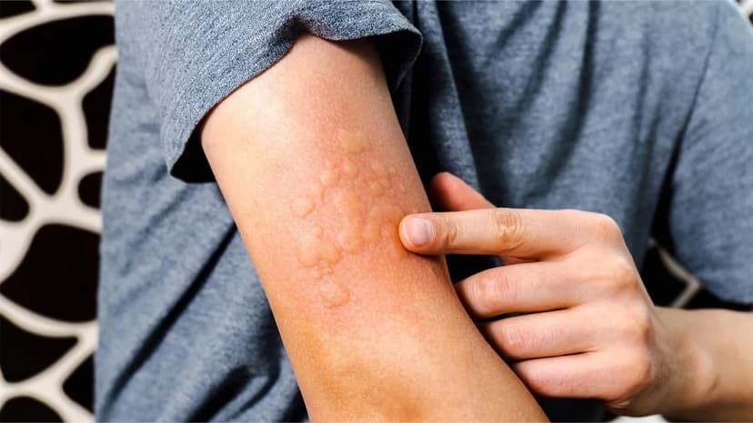 Nổi mề đay có tự hết không?