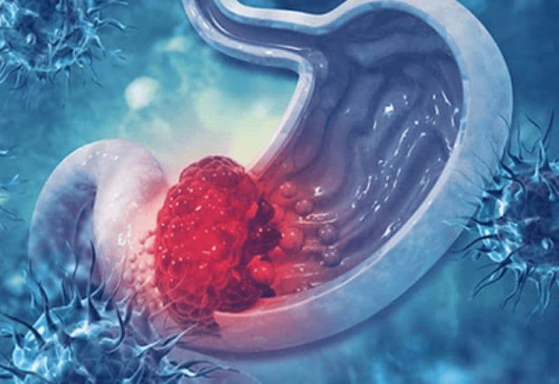 nội soi tiền ung thư