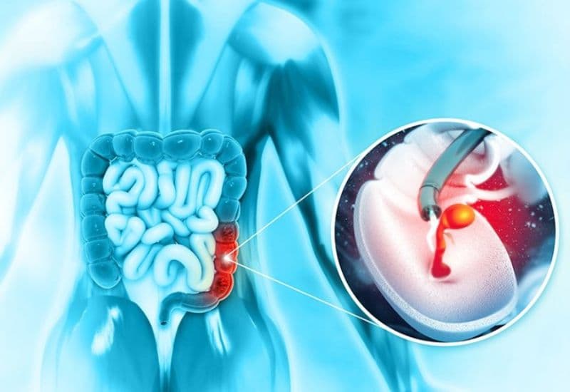 nội soi tiền ung thư