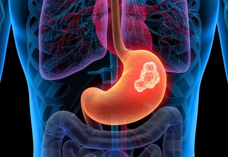 nội soi tiêu hóa phát hiện ung thư không