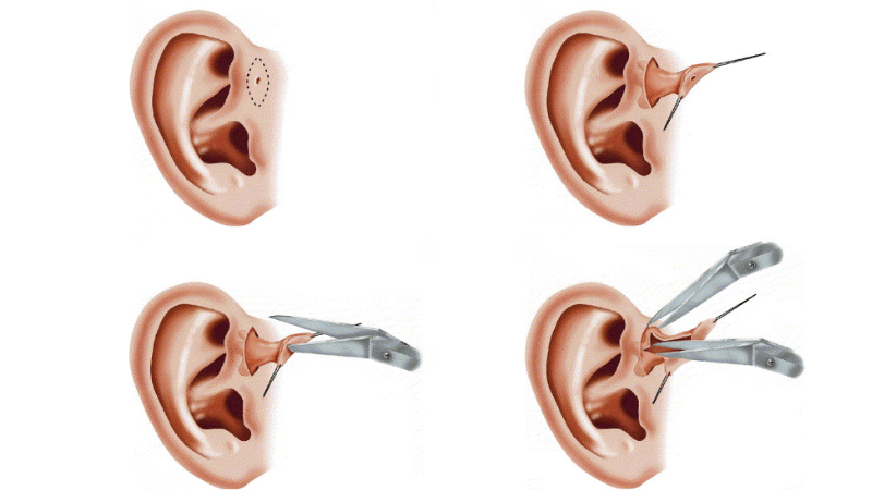 phẫu thuật rò luân nhĩ