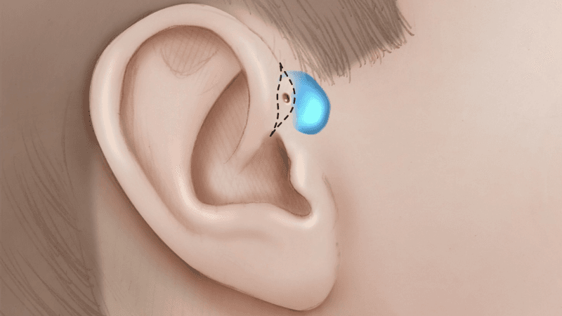 phẫu thuật rò luân nhĩ