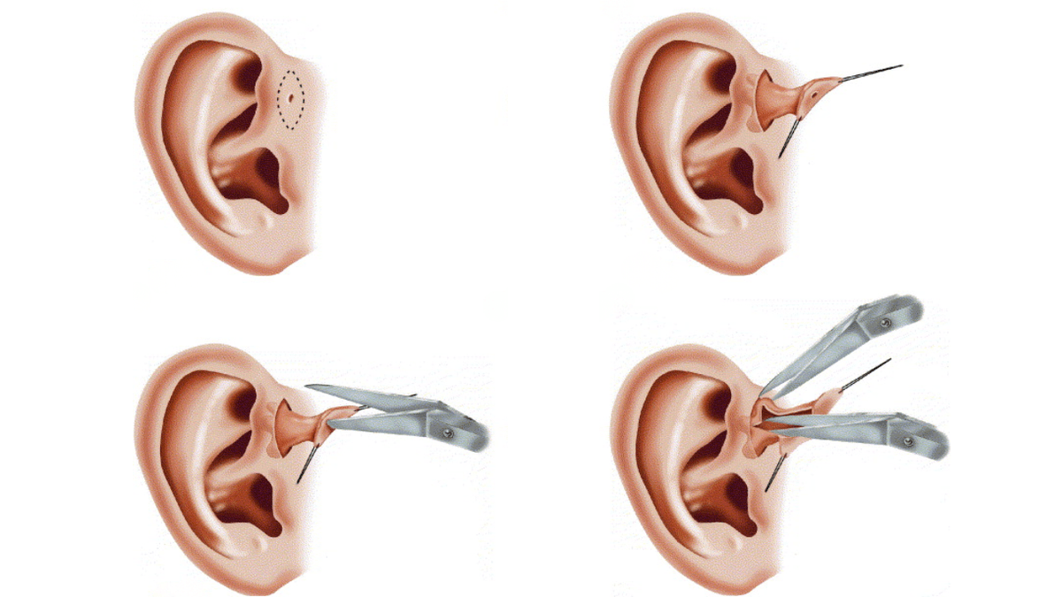 Chi định phẫu thuật rò luân nhĩ