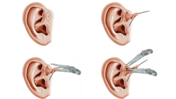 Chi định phẫu thuật rò luân nhĩ