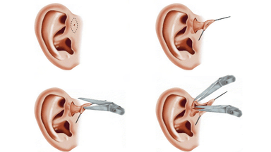 Chi định phẫu thuật rò luân nhĩ