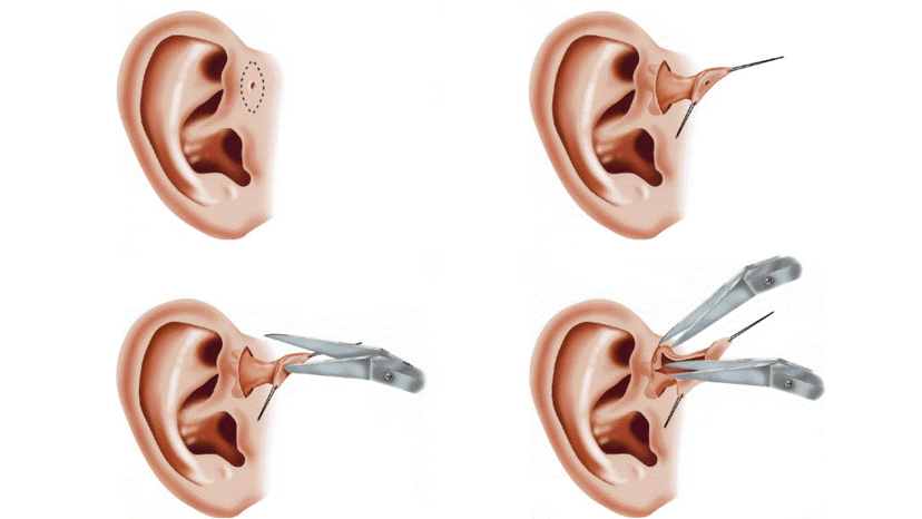 Chi định phẫu thuật rò luân nhĩ