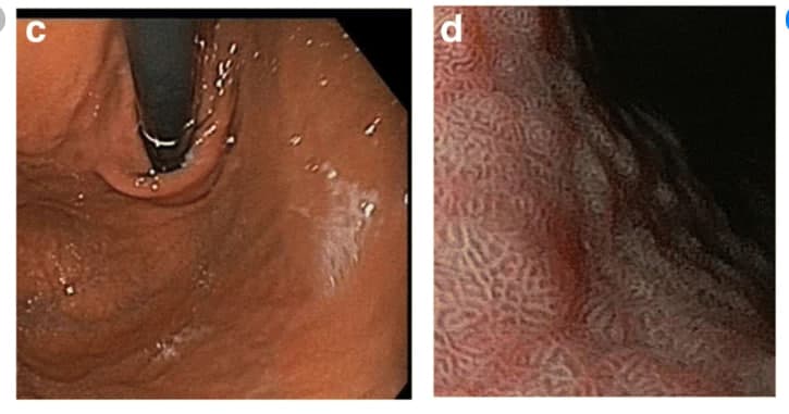 hình ảnh viêm teo niêm mạc dạ dày