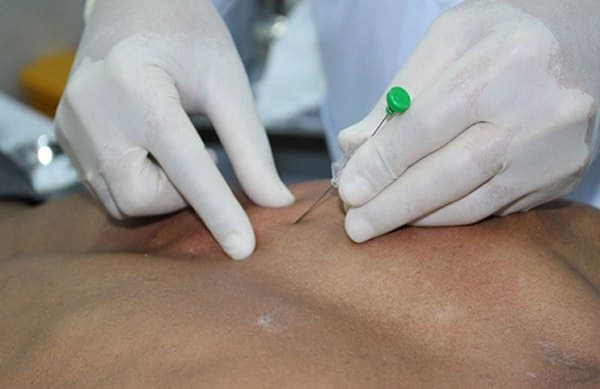 thủy châm giảm đau vai gáy