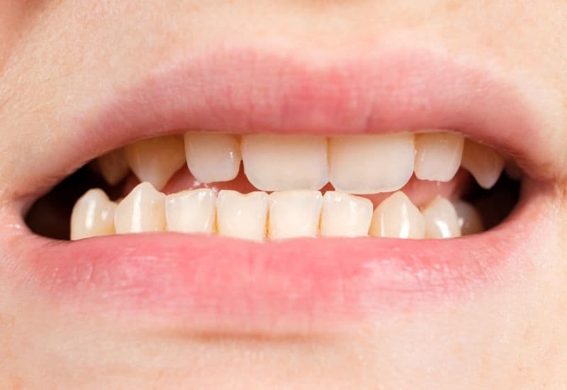 răng sữa bị mòn có nên nhổ