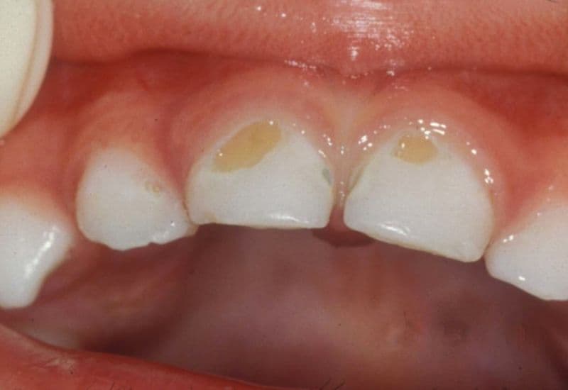 răng sữa bị sâu có nên nhổ