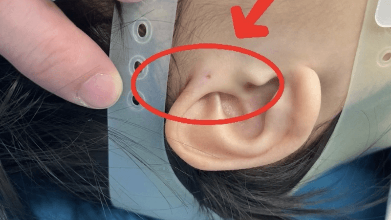 rò luân nhĩ có di truyền không