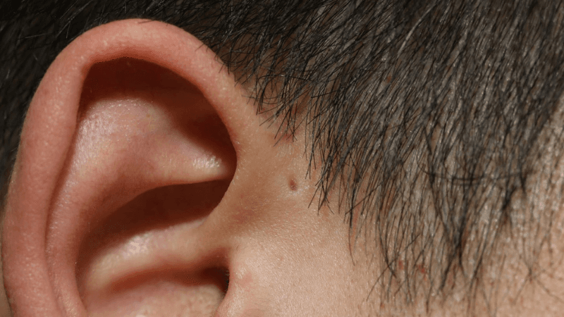 rò luân nhĩ là gì