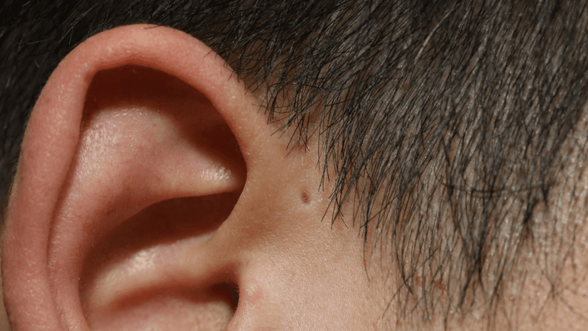 Rò luân nhĩ là gì? Có nguy hiểm không?