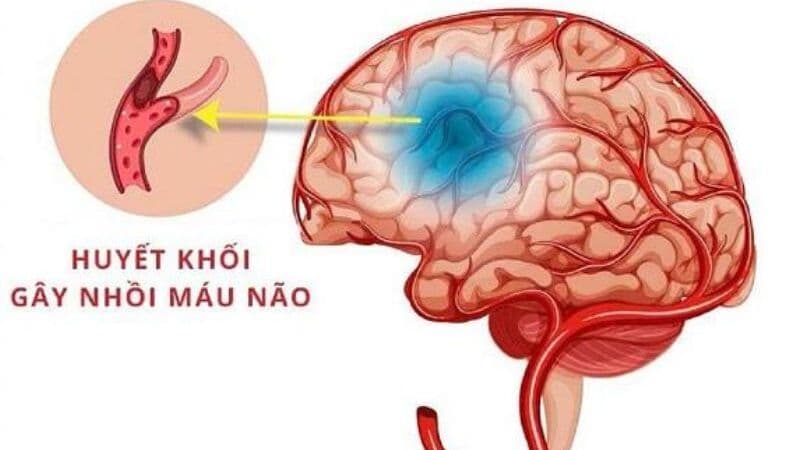 RTPA trong nhồi máu não