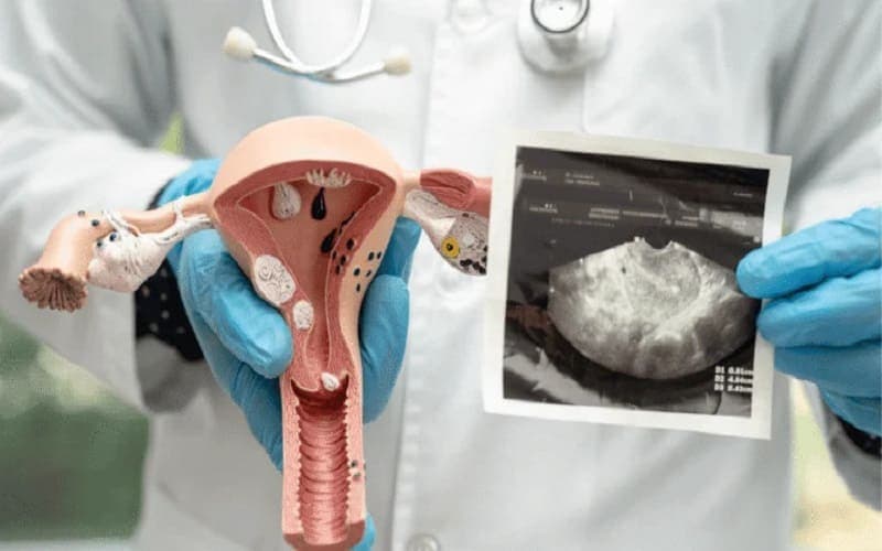 dấu hiệu đa nang buồng trứng ở tuổi dậy thì