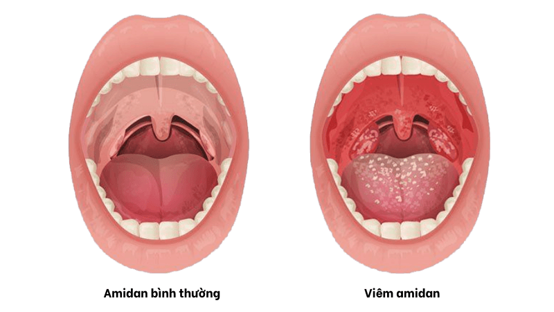 sốt viêm amidan ở trẻ kéo dài bao lâu